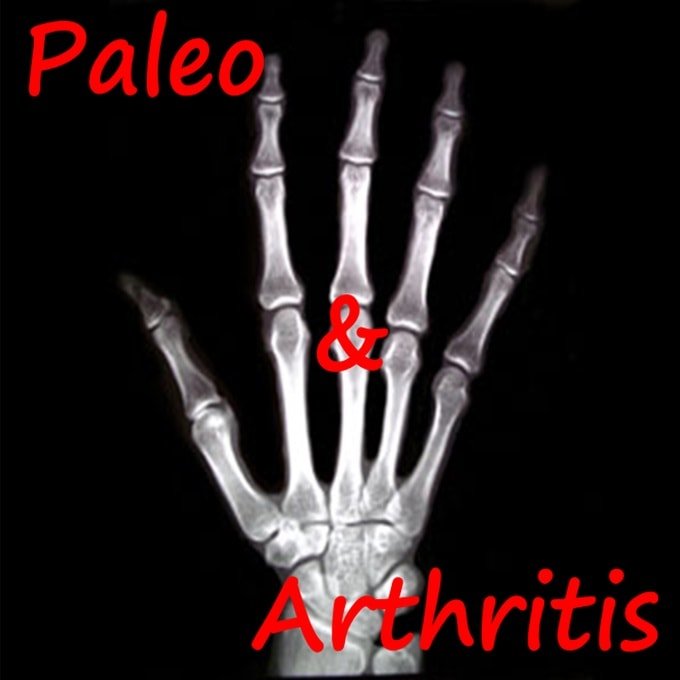Paleo diet arthritis rheumatoid Osteoarthritis Psoriatic-min
